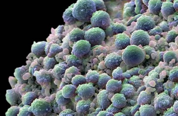 Descubren virus que detiene crecimiento de células cancerosas celula cancerosa