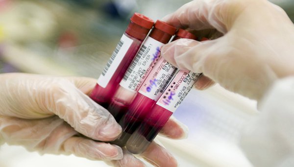 Diagnóstico de cáncer intestinal a través de análisis de sangre