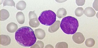 Curso de Posgrado a distancia: Leucemias Agudas
