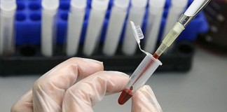 Utilidad del Indice de Mentzer en el screening de β-talasemia menor