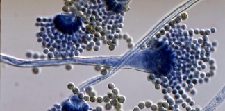 El espectro clínico de la aspergilosis pulmonar