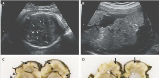 Prueban por primera vez la relación entre el virus Zika y la microcefalia