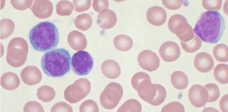 Algoritmos matemáticos contra la leucemia