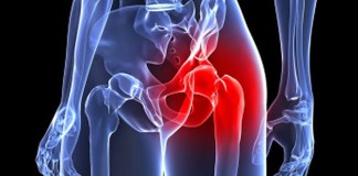 Nuevos biomarcadores de diagnóstico precoz de artrosis de cadera