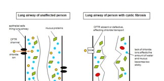 Diagnóstico de Fibrosis Quística en muestras de sangre seca
