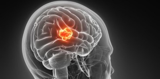 Scientists turn skin cells into stem cells that kill brain cancer