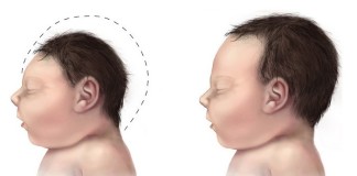 El efecto del virus Zika sobre el feto podría ser incluso más letal de lo que se pensaba