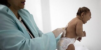Estados Unidos confirma el vínculo entre el virus Zika y la microcefalia