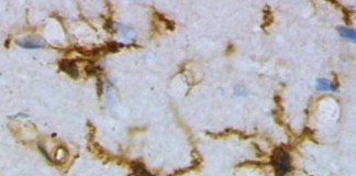 Biomarcador en LCR se eleva en estadios tempranos de Alzheimer