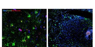 Identifican el primer marcador bioquímico y molecular del glioblastoma