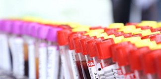 Una revisión sobre la Hemocromatosis