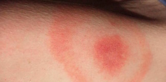 La creciente amenaza de la enfermedad de Lyme