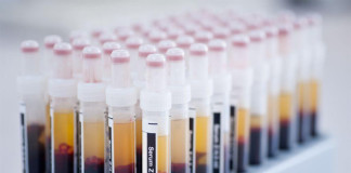 Elevada incidencia de reinfección por el virus de la hepatitis C en HSH con VIH