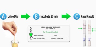 Un análisis de orina para diagnosticar la malaria