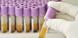 Marcador en plasma para enfermedad vascular en diabetes