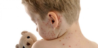 La varicela puede reducir el riesgo posterior de sufrir un cáncer de cerebro