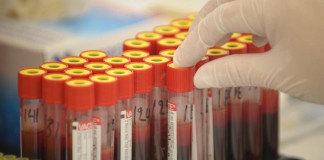 Análisis de colesterol: ¿es necesario el ayuno?