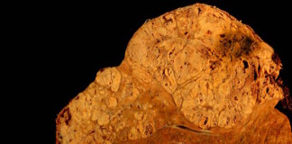 Niveles bajos de selenio se asocian con el desarrollo de cáncer de hígado