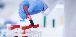 Uricemia para predecir la evolución de la insuficiencia cardíaca