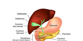 Actualización sobre diagnóstico de litiasis biliar
