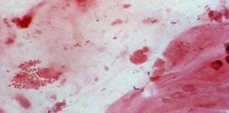 Gonorrhea May Become Resistant to All Antibiotics Sooner Than Anticipated