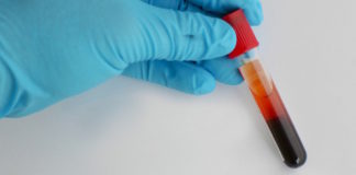 Un nuevo blanco terapéutico para el cáncer de páncreas