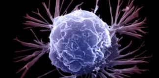 Immune cells may facilitate tumor growth by forming primitive vascular channels