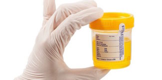 El lipoarabinomanano urinario puede detectar tuberculosis activa