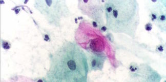 Descubren mecanismo que desarrolla la oncoproteína E7 del VPH