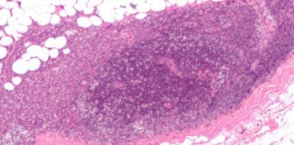 Exposure to BPA substitute, BPS, multiplies breast cancer cells