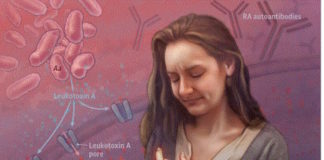 Oral bacteria may set off a cascade of events that leads to the autoimmune form of arthritis.