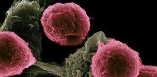 Nuevas vacunas personalizadas contra el melanoma