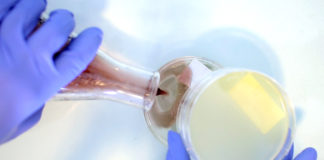 Candidiasis vulvovaginal recurrente: un problema común en la práctica clínica