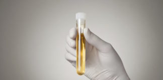 Un test genético de orina para predecir la recurrencia del cáncer de vejiga