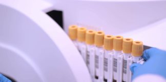 Los niveles de succinato en sangre predicen la remisión de la diabetes tipo 2