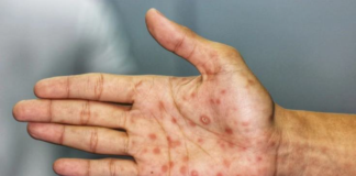 En cinco años se cuadruplicaron los casos de sífilis