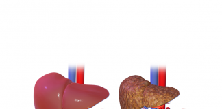 Identificada la firma molecular en sangre de la fase más grave de la cirrosis