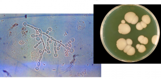 Aporte del Laboratorio al diagnóstico de la Candidiasis Vulvovaginal Recurrente Alérgica