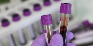 Rol del laboratorio en los pacientes con COVID-19 Persistente o Long COVID